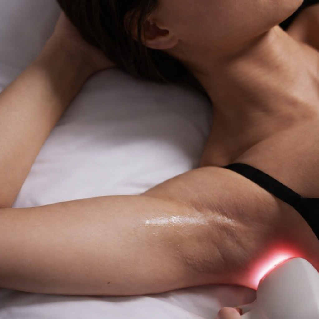 Lasersko odstranjevanje dlak v salonu Gliese